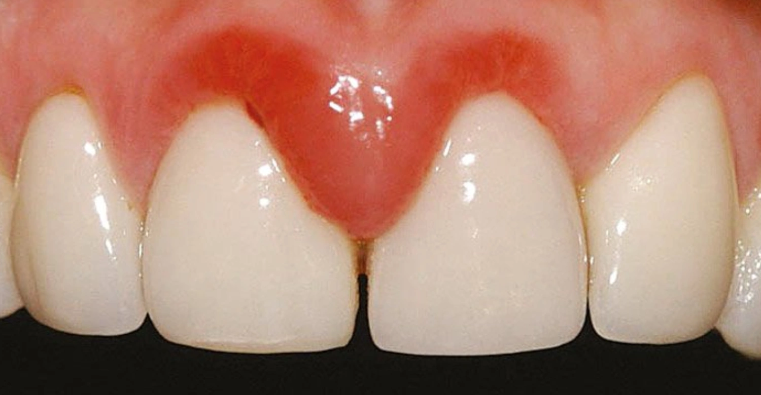 Chronic Gingivitis Inblog